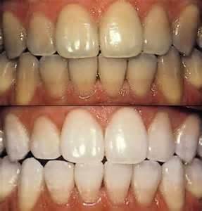 Teeth white and not.jpg?1365303753660